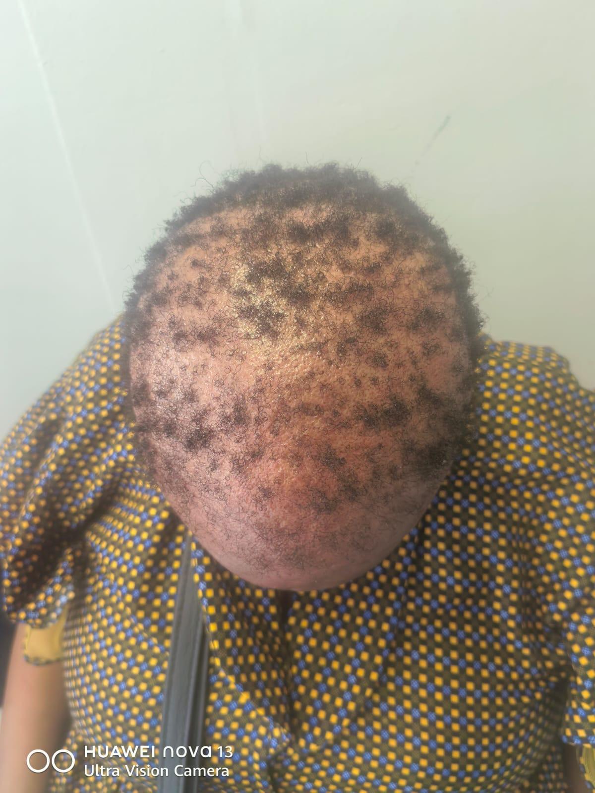 Before Treatment